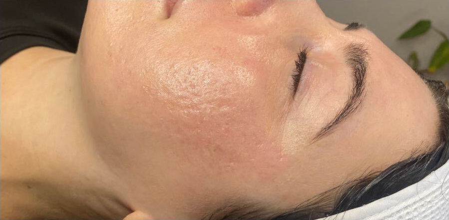 Scar revision program, after treatment