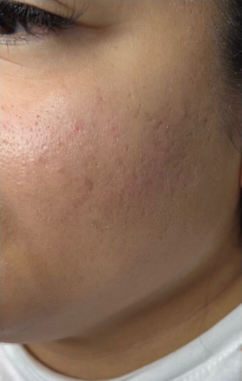 Plasma and skin needling program, after treatment