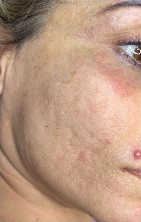 PlasmaPen and skin needling, after treatment
