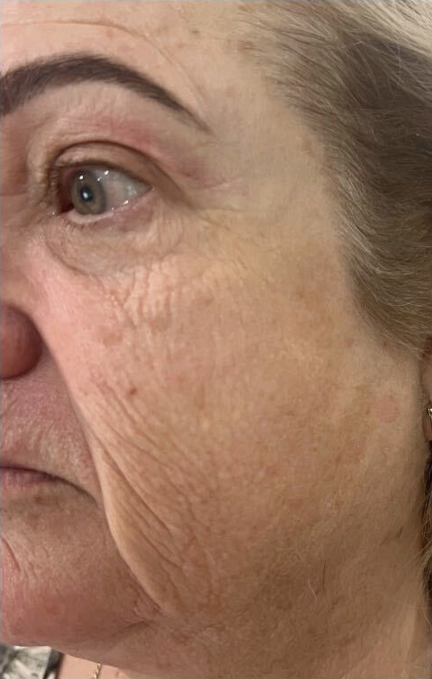Jawline refinement, after treatment