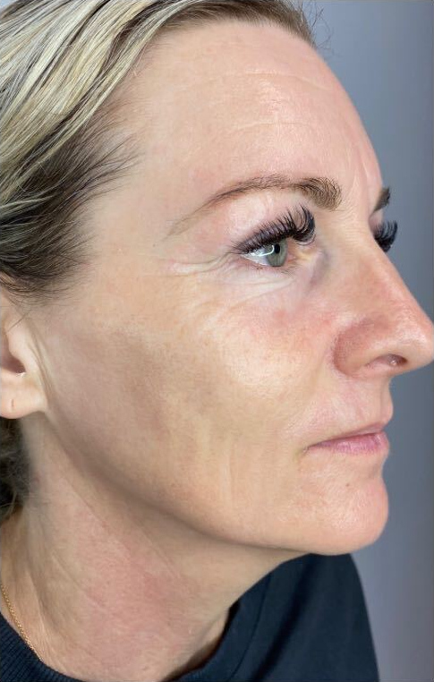 Facial skin tightening, after treatment