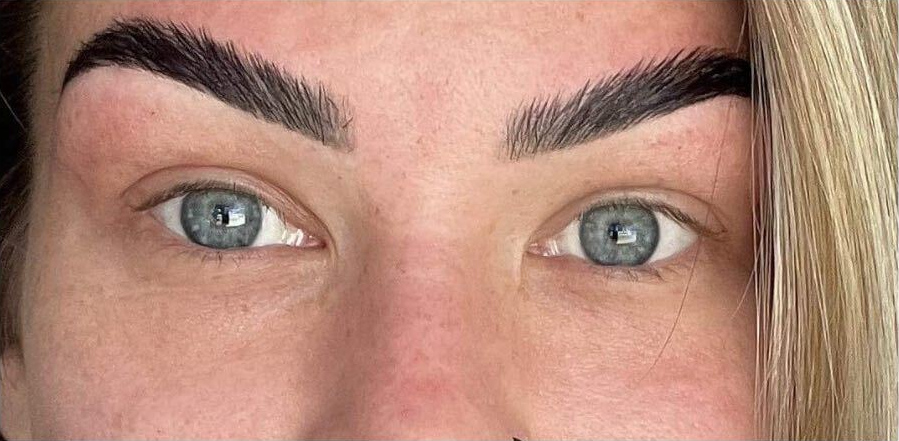 Upper eyelid refinement, after treatment