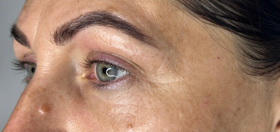 Upper and lower eye area, after treatment