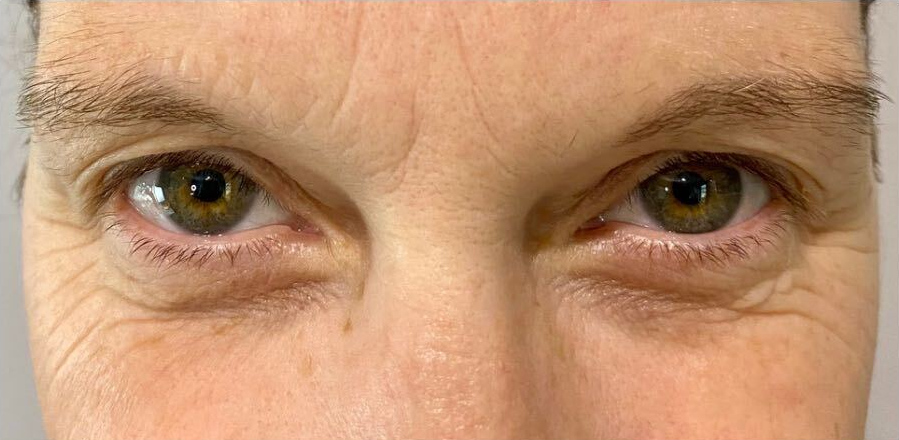 Upper eyelid refinement, before treatment