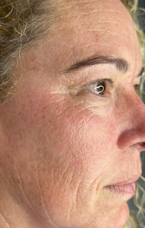 BioRePeel treatment course, before treatment