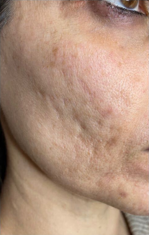 PlasmaPen and skin needling, before treatment