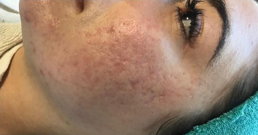 Scar revision program, before treatment