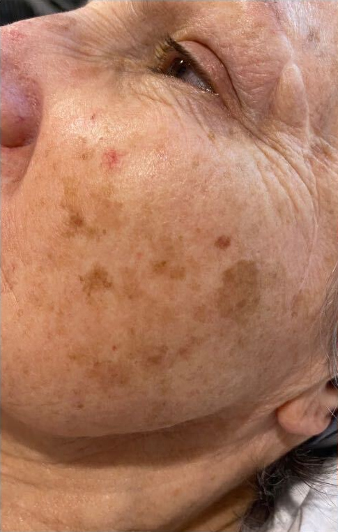 Sun spot treatment program, before treatment