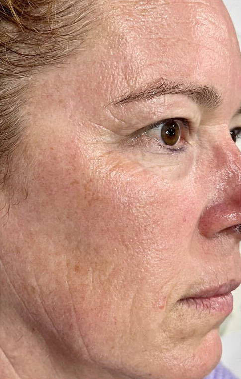 BioRePeel treatment course, after treatment