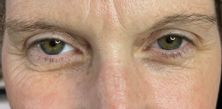 Upper eyelid refinement, after treatment