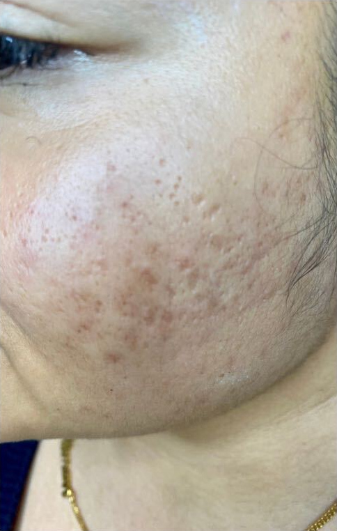 Plasma and skin needling program, before treatment