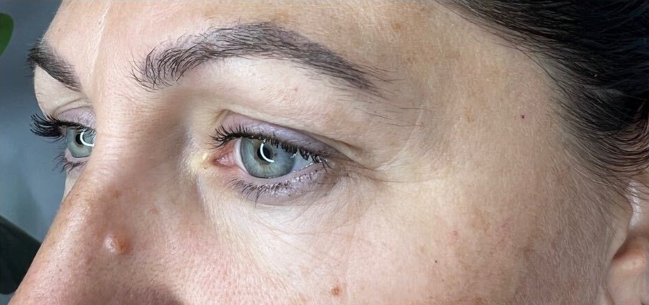 Upper and lower eye area, before treatment