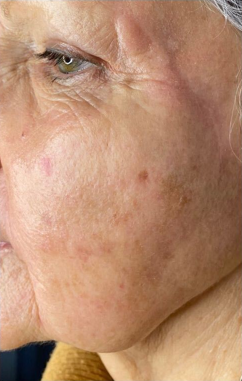 Sun spot treatment program, after treatment