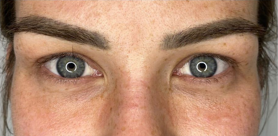 Upper eyelid refinement, before treatment