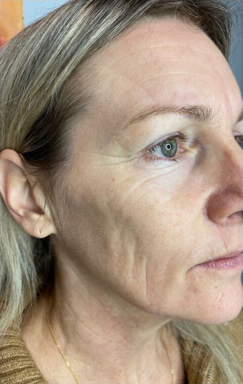 Facial skin tightening, before treatment